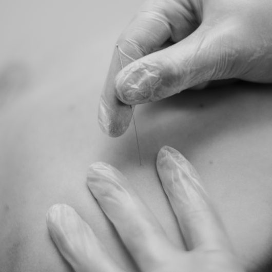 Fysiotherapie, Fysiotherapeut, Fysiotherapiepraktijk, Fysio, Beek, Kuijs Fysiotherapie, Fysiofitcare, Dry Needling