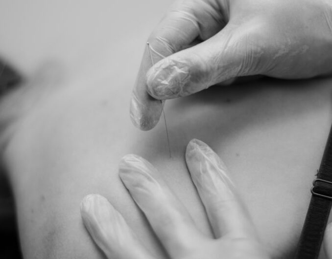 Fysiotherapie, Fysiotherapeut, Fysiotherapiepraktijk, Fysio, Beek, Kuijs Fysiotherapie, Fysiofitcare, Dry Needling